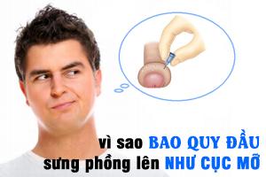 Bao quy đầu sưng phòng như cục mỡ Bao quy đầu sưng phòng như cục mỡ