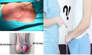Chấn thương tinh hoàn ở nam giới Chấn thương tinh hoàn ở nam giới